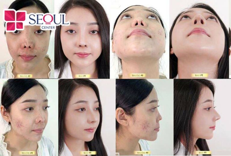 Sử dụng dịch vụ sửa mũi hỏng mức độ đặc biệt tại Seoul Center sẽ giúp bạn lấy lại tự tin cho diện mạo