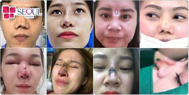 Những trường hợp mũi hỏng ở mức độ đặc biệt