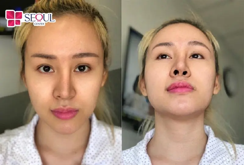 Sửa mũi hỏng mức độ khó là giải pháp khắc phục mũi bị lệch vẹo sống mũi, đầu mũi bóng đỏ, mũi viêm nhiễm sưng kéo dài