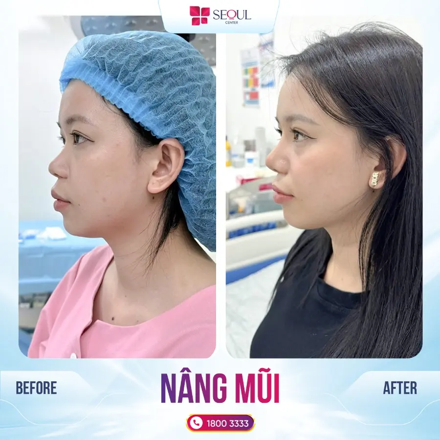 Sửa mũi mức độ khó kết hợp nâng mũi tại Seoul Center bạn sẽ yên tâm về chất lượng dịch vụ