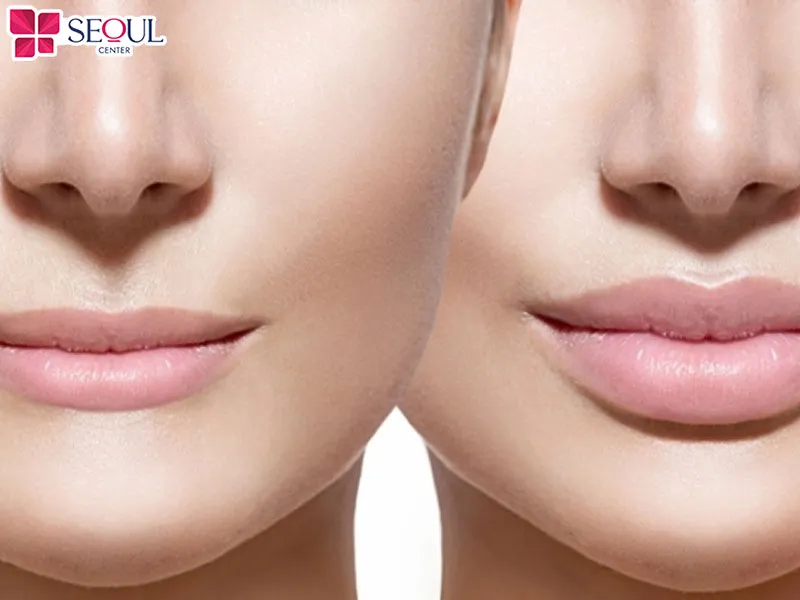 Thu mỏng môi trên là giải pháp loại bỏ niêm mạc môi trên dư thừa, giúp cho môi trở nên thon gọn hơn