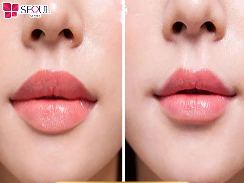 Thu mỏng môi trên giúp điều chỉnh độ dày của niêm mạc môi, giúp cho môi cân xứng với tỷ lệ gương mặt hơn