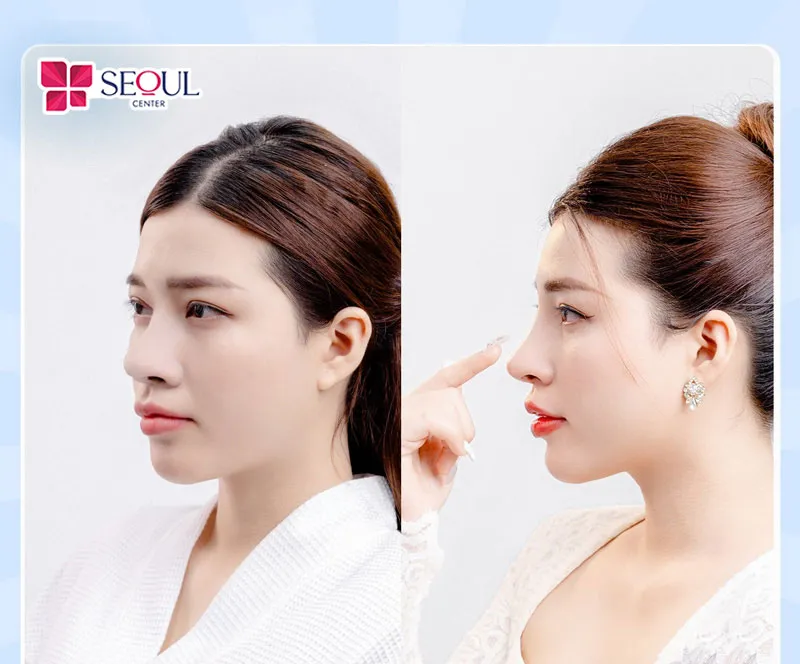 Dáng mũi to, sóng dài thô được khắc phục hiệu quả nhờ phương pháp thu ngắn sóng mũi tại Seoul Center