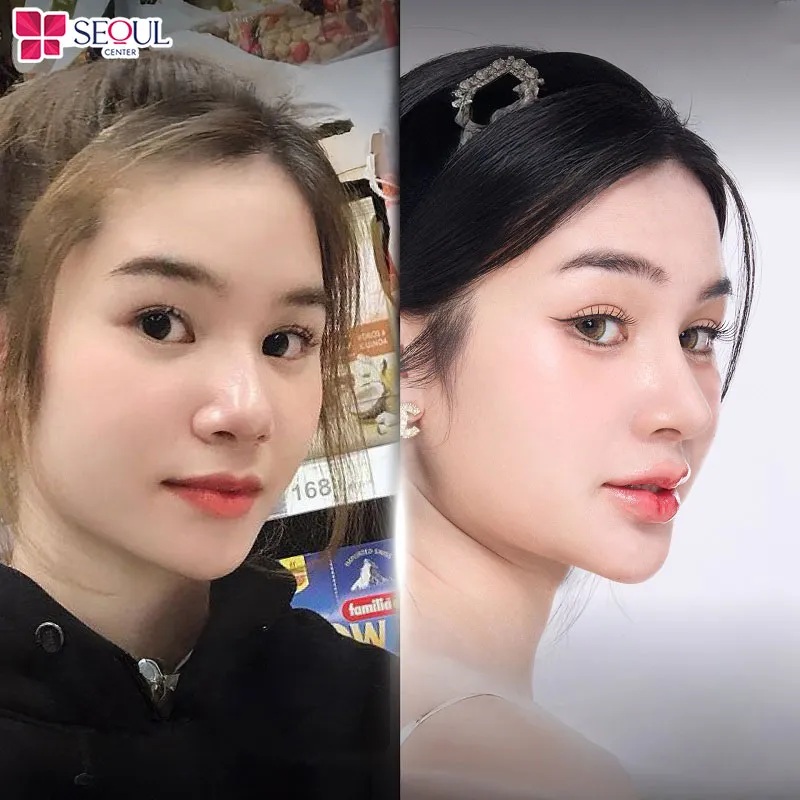 Phương pháp thu ngắn sóng mũi giúp dáng mũi vào form cực đẹp, sang, tôn lên đường nét gương mặt khách hàng, đặc biệt duy trì hiệu quả lâu dài