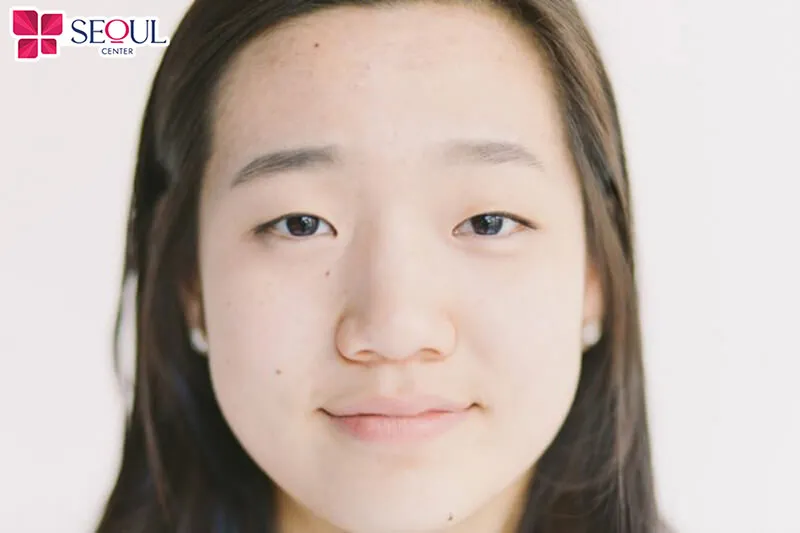 Thu ngắn sóng mũi phù hợp với những người có sóng mũi quá dài, cánh mũi bè