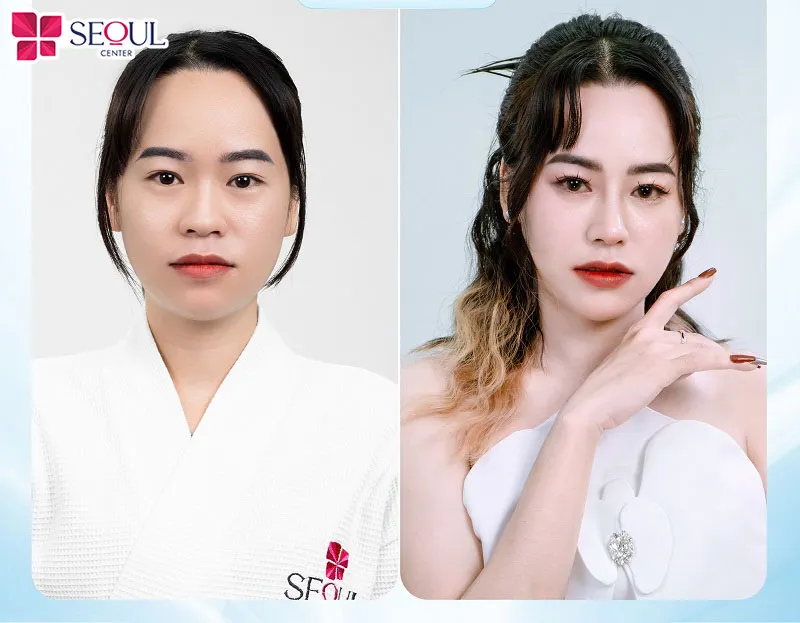 Cô gái “lột xác” sau khi thực hiện dịch vụ thẩm mỹ mũi tại Seoul Center