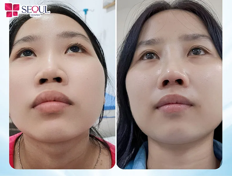 Thu ngắn sóng mũi tại Seoul Center tạo dáng mũi đẹp hài hòa gương mặt