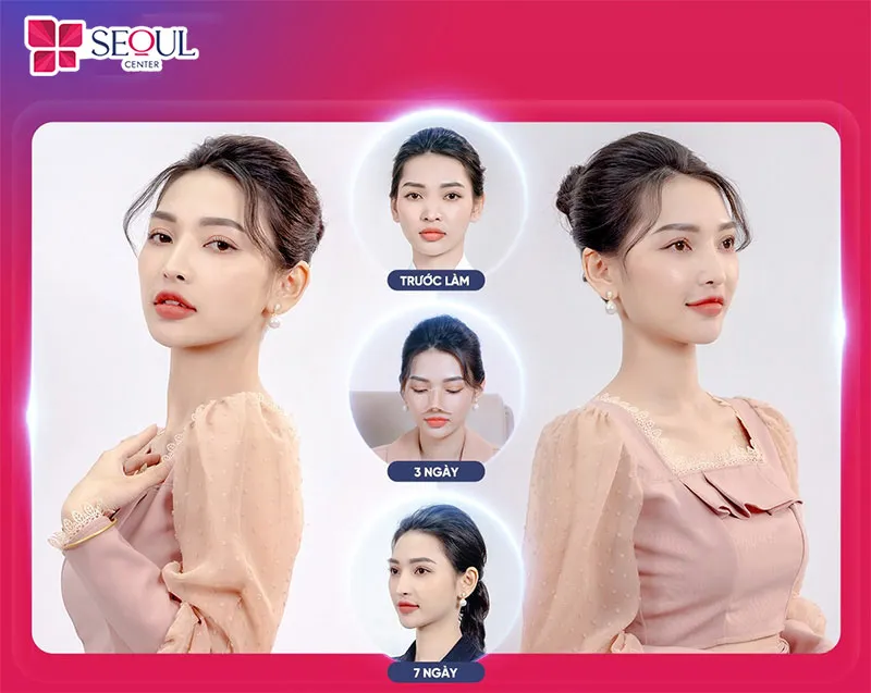 Thu ngắn sóng mũi kiến tạo dáng mũi chuẩn tỉ lệ vàng cho khách hàng