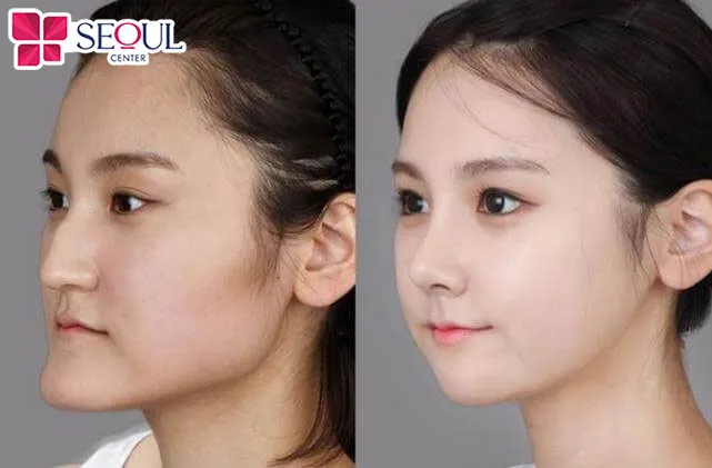 Xử lý cằm cũ tạo dáng cằm mới cân đối hài hòa gương mặt hơn