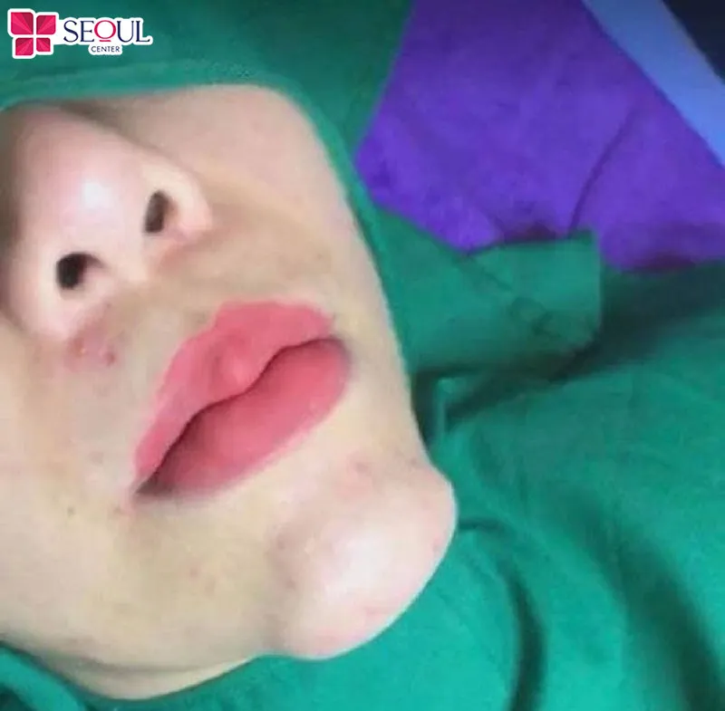 Những ai có cằm bị hỏng, biến chứng do lần thẩm mỹ trước có thể tham khảo dịch vụ xử lý cằm tại Seoul Center