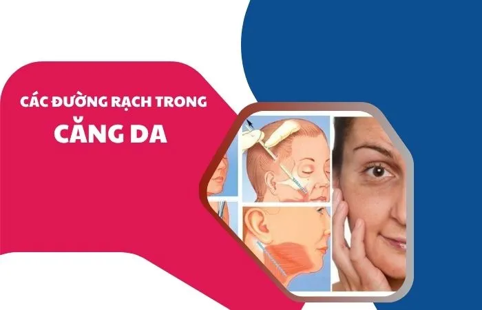 Các đường rạch trong căng da