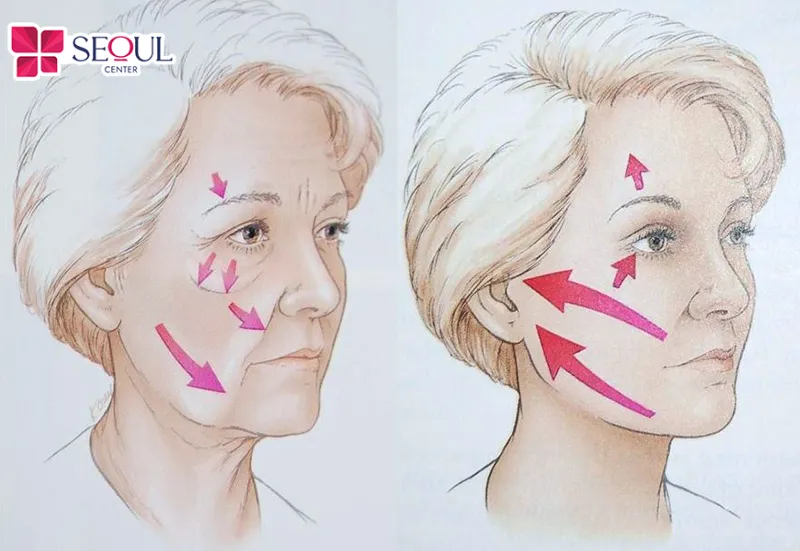 Thị trường căng da mặt tại Việt Nam ngày càng tăng trưởng sôi động