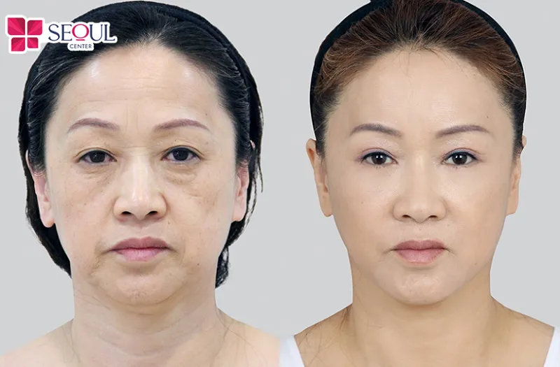 Mỗi kỹ thuật căng da đều có đặc điểm khác nhau, nhưng đều giúp trẻ hóa diện mạo