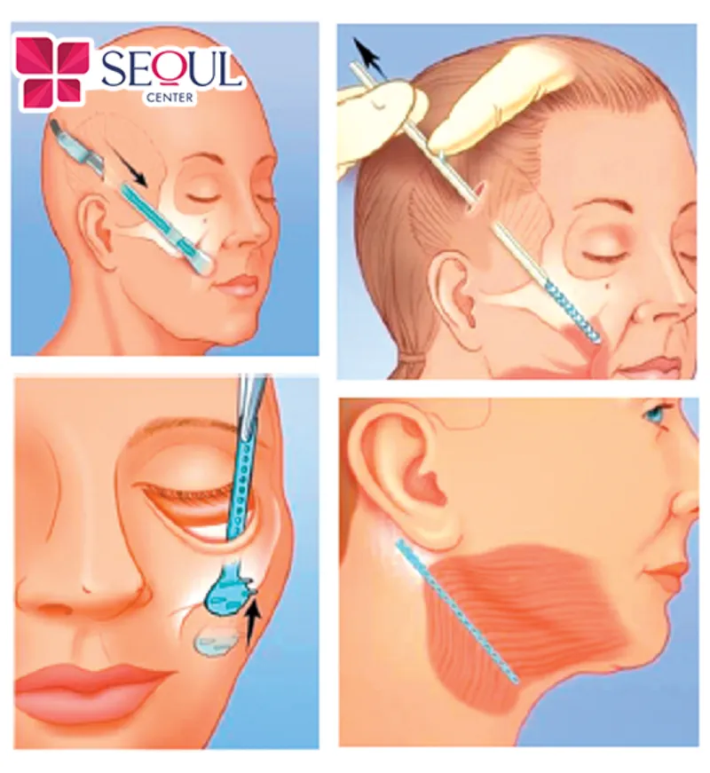 Mỗi đường rạch sẽ phù hợp với từng kỹ thuật căng da khác nhau