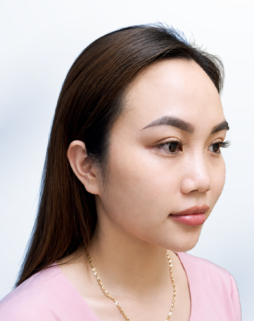 Trước khi làm nhìn nghiêng không thấy sống mũi