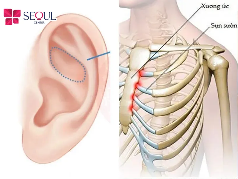 Sụn sườn tự thân được lấy từ xương sườn nguồn cung dồi dào, độ tương thích cao, hạn chế biến chứng, duy trì bền lâu, nhưng chi phí cao