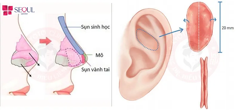 Sụn vành tai/vách ngăn có độ tương thích cao, đảm bảo an toàn, tự nhiên, nhưng nguồn cung hạn chế, kỹ thuật phức tạp