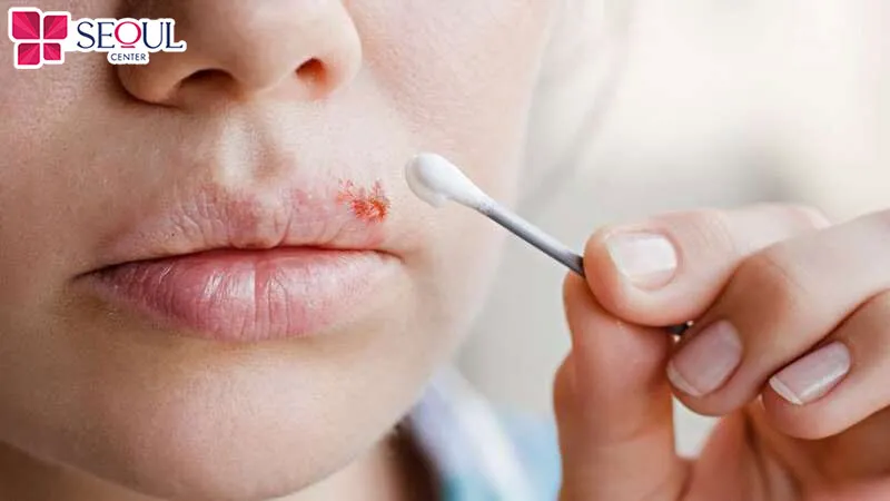 Bôi thuốc Acyclovir lên vùng môi bị nổi mụn nước sau ăn và trước khi ngủ