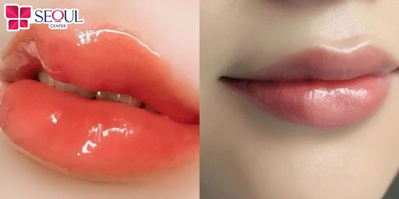 Phun môi pha lê và phun môi collagen vẫn có những điểm tương đồng như khắc phục môi thâm xỉn màu