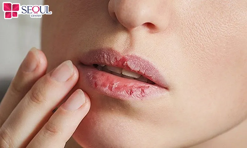 Môi bị thiếu nước khiến cơ thể tăng sản sinh melanin