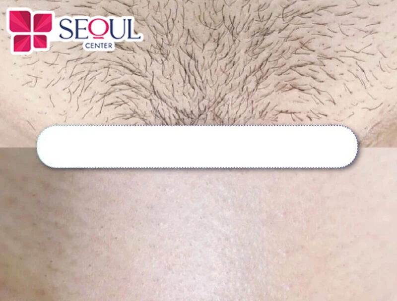 Công nghệ triệt lông cùng đội ngũ chuyên viên tại Thẩm mỹ viện Seoul Center sẽ giúp khách hàng loại bỏ lông vùng kín an toàn, hiệu quả, không đau