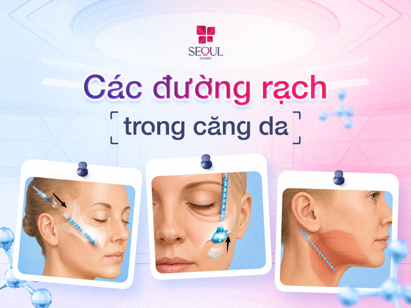 Các đường rạch trong căng da