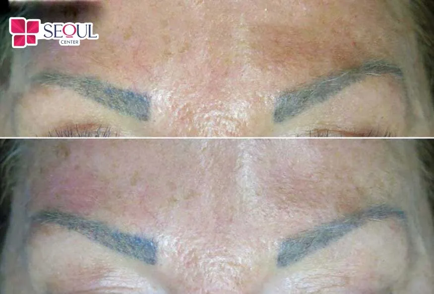 Chân mày trổ xanh, trổ đỏ sau xăm là một trong những dấu hiệu nhận biết chân mày bị lỗi