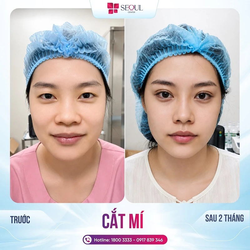 Để sở hữu mí mắt đẹp sau cắt mí, bạn cần chăm sóc, kiêng cữ khắt khe để nếp mí vào form rõ rệt