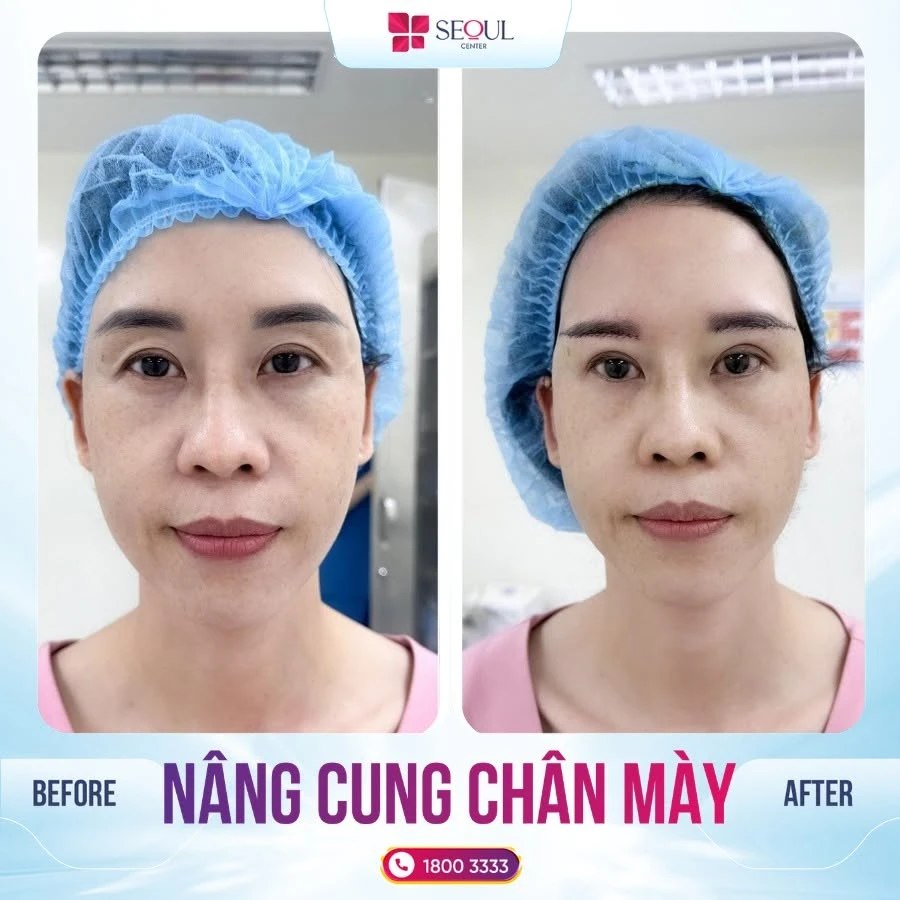 Chăm sóc vùng thẩm mỹ cẩn thận sau phẫu thuật sẽ mang lại kết quả như mong muốn