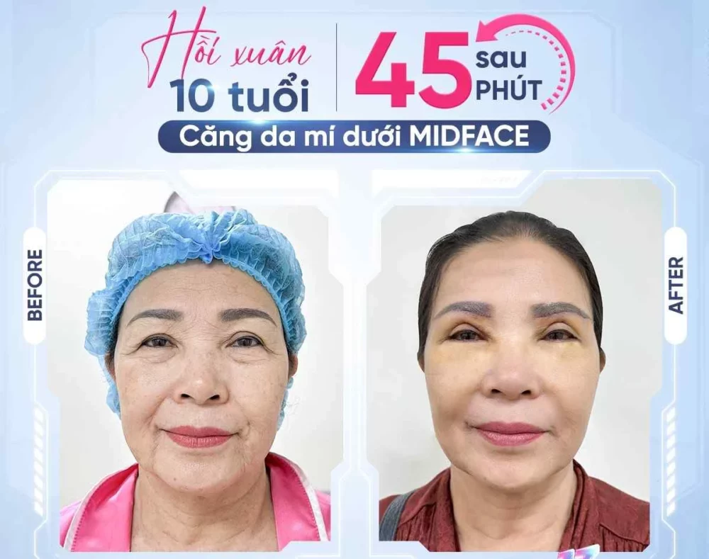 Sau khi thực hiện các dịch vụ căng mí, vết thương cần chăm sóc cẩn thận để tránh nhiễm trùng, sưng tấy kéo dài