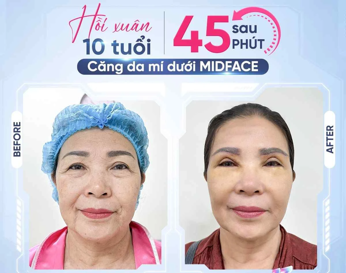 Sau khi thực hiện các dịch vụ căng mí, vết thương cần chăm sóc cẩn thận để tránh nhiễm trùng, sưng tấy kéo dài
