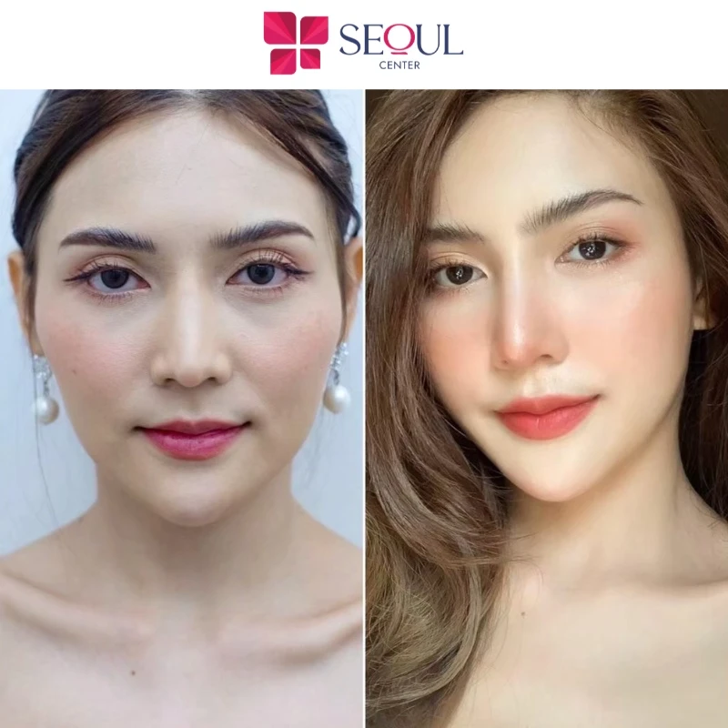 Sau khi tiêm Filler, quý khách hàng cần kiêng cữ khắt khe để vùng tiêm không bị sưng viêm, nhiễm khuẩn, xô lệch chất làm đầy