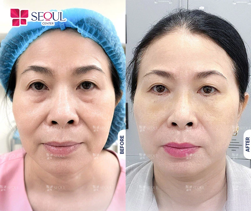 Sau khi tiêm Botox bạn cần ăn uống ngủ nghỉ sinh hoạt đúng hướng dẫn để vết thương mau lành, Botox phát huy tác dụng nhanh