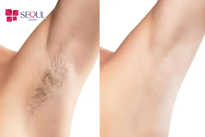 Triệt lông đúng quy trình chuẩn sẽ mang lại hiệu quả vượt trội