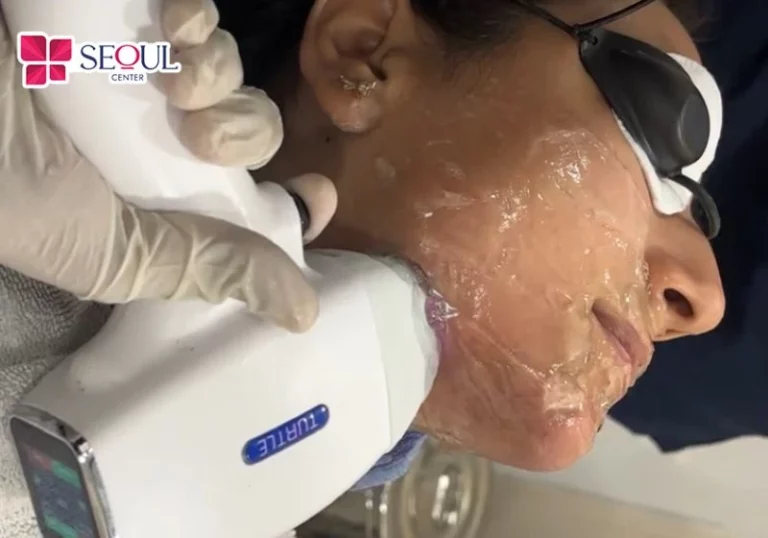 Công nghệ triệt lông hiện đại giúp giảm mọc ria mép hiệu quả và lâu dài.