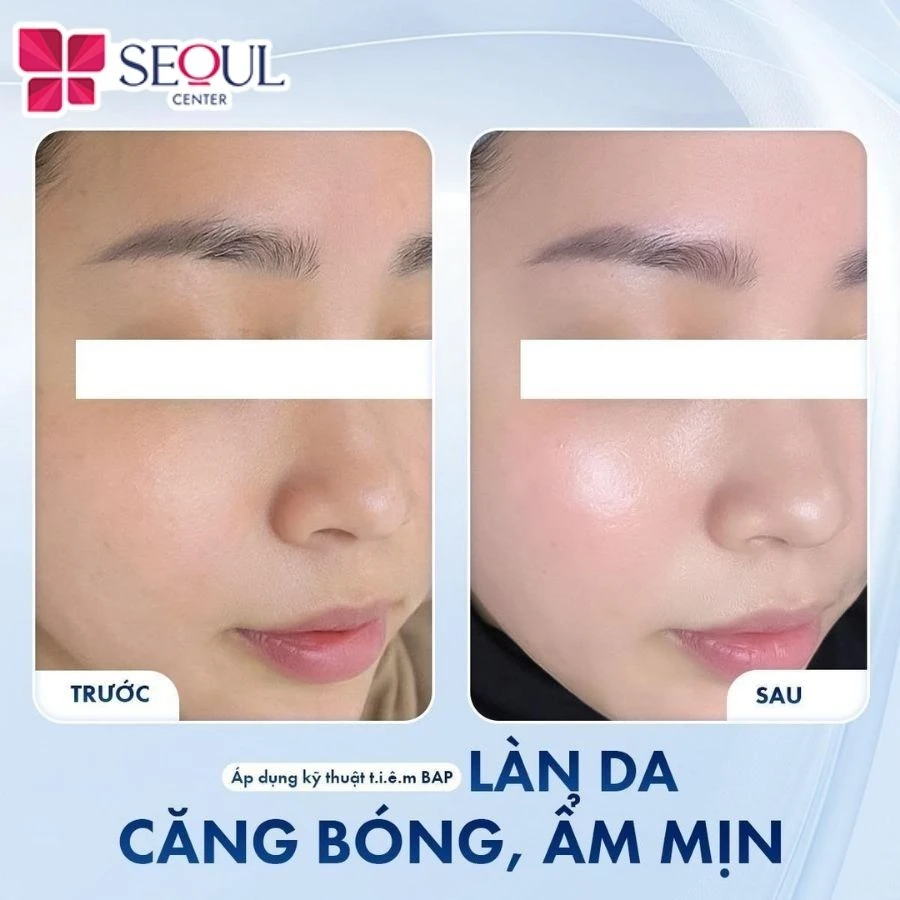 Làn da khách hàng căng bóng, ẩm mịn ngay sau khi sử dụng sản phẩm Genyalift thông qua kỹ thuật tiêm BAP tại Seoul Center