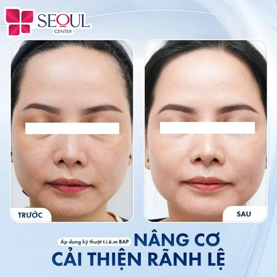 Làn da khách hàng trước và sau khi tiêm BAP đưa Genyalift vào da
