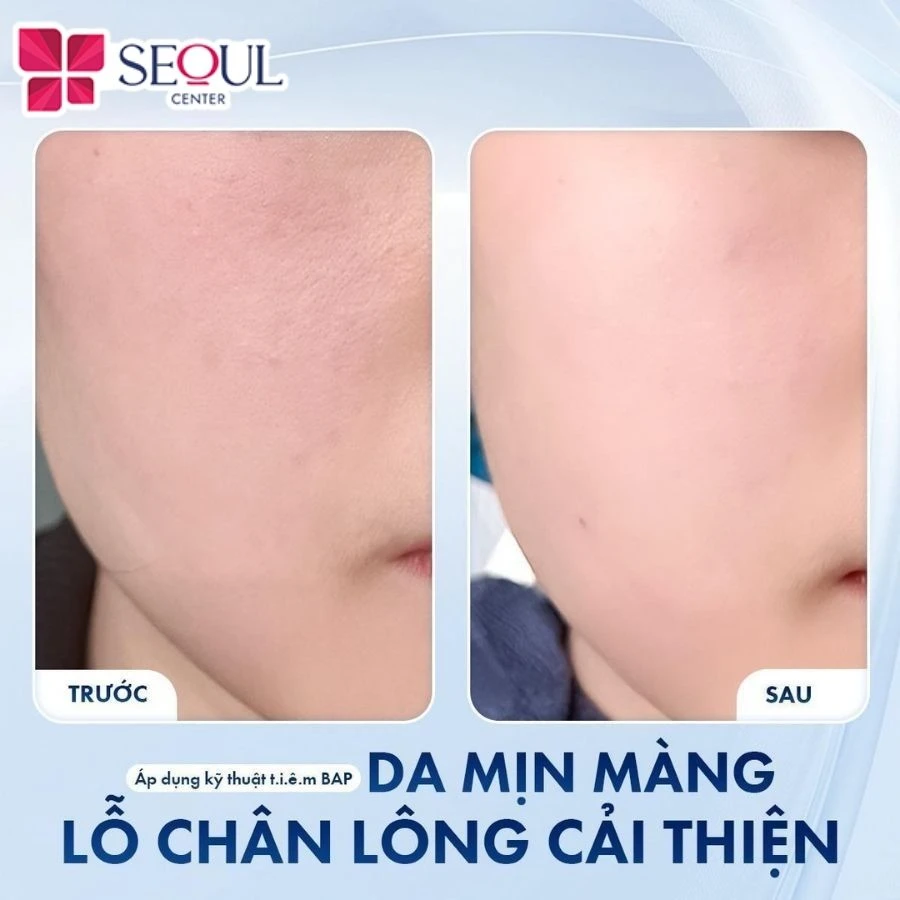 Da khách hàng mịn màng hơn sau khi sử dụng Genyalift bằng kỹ thuật tiêm BAP