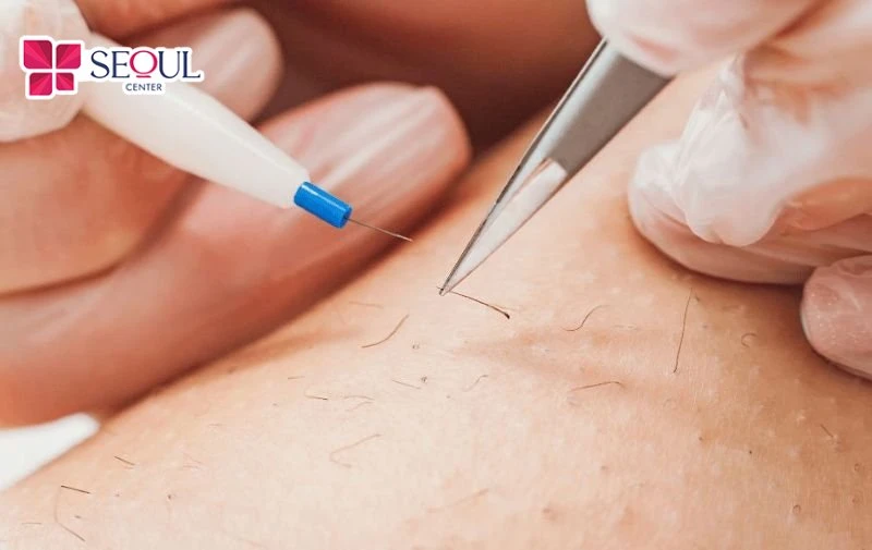 Hình ảnh triệt lông điện phân tận gốc.