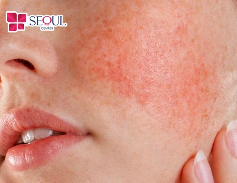 Thực hiện sai kỹ thuật triệt lông điện phân có thể dẫn đến kích ứng da