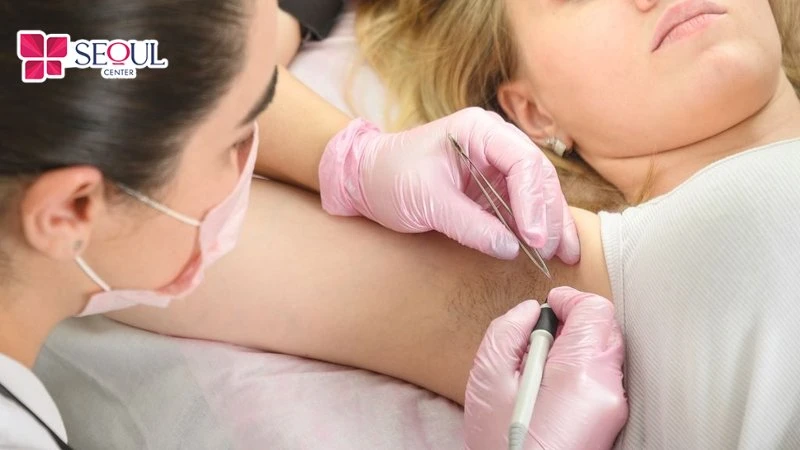 Chi phí triệt lông điện phân dao động từ 1.5 triệu đến 20 triệu