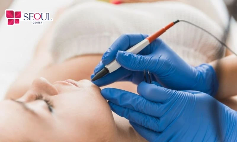Kỹ thuật viên đang tiến hành điện phân nang lông bằng đầu kim siêu nhỏ.