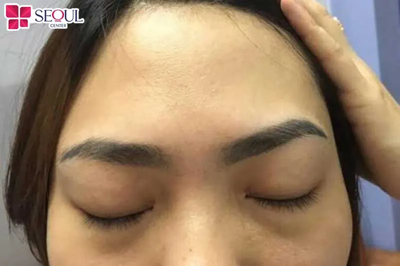 Chân mày bị lệch, không cân đối hai bên cũng là lỗi thường gặp sau xăm do kỹ thuật viên tay nghề kém