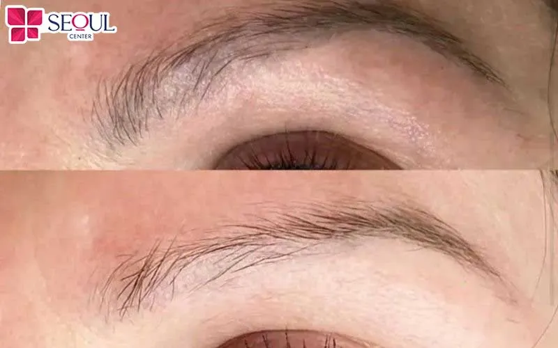 Tần suất xóa xăm để loại bỏ hoàn toàn tàn dư của mực xăm cũ cần lộ trình từ 3 - 5 lần