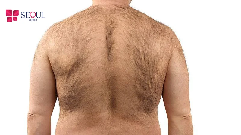 Đàn ông có xoáy lông trên lưng có khí chất mạnh mẽ và tài chính vững vàng