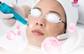 Điều trị nám - Laser sắc tố Matrix