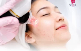 Laser Điều Trị Mụn Matrix