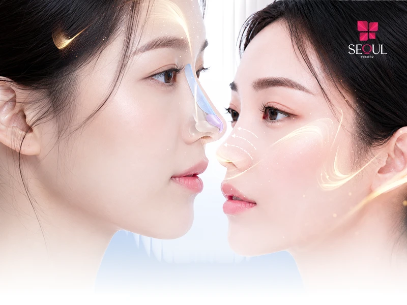 Nâng mũi bán cấu trúc Nano Mỹ