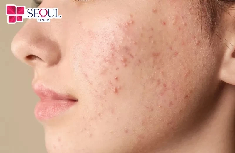 Cạo lông mặt không đúng cách có thể khiến da bị kích ứng, nổi mụn