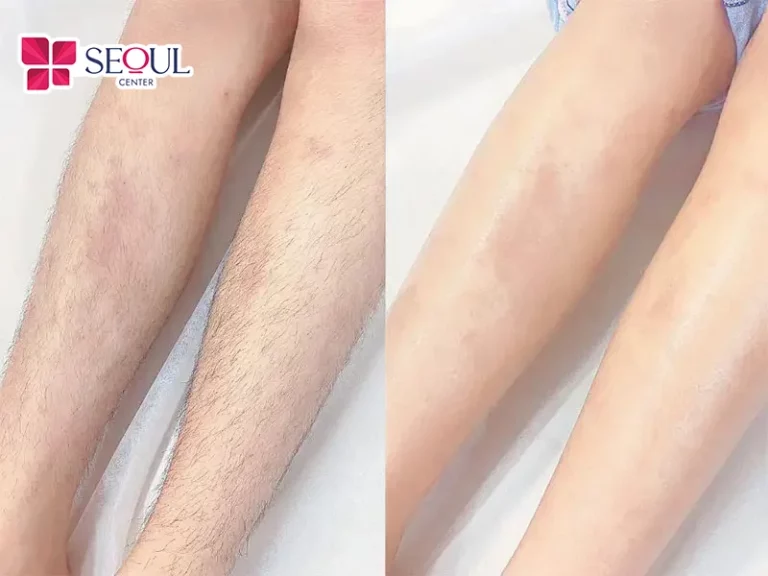 Công nghệ triệt lông DPL sở hữu nhiều ưu điểm vượt trội như an toàn, tiết kiệm chi phí